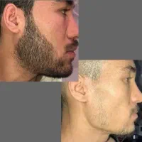 تراپی ریشات