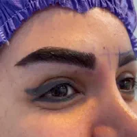 کاشت مو، ابرو و ریش با حداکثر تراکم به قیمت قبل