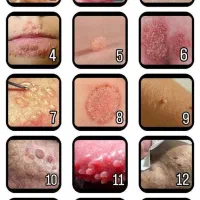 رفع کامل hpv  به روش نوین