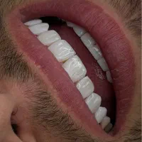 خدمات دندان کامپوزیت روکش با ٪۳۰٪ تخفیف ویژه