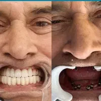 ایمپلنت و لمینت، کرج