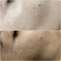 تخفیف ویژه رفع کک و مک و تیرگی صورت