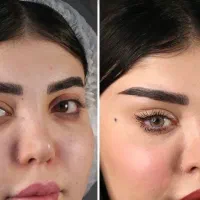 بلفاروپلاستی پلک لیفت صورت و ابرو در جشنواره