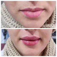 پرسینگ رایگان در کنار خدمات ژل،بوتاکس،پی آرپی
