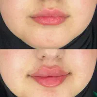 ژل بوتاکس مزو