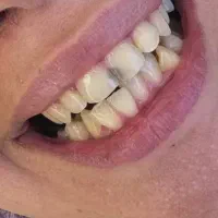 دندانپزشکی/ کامپوزیت/ایمپلنت/لمینت