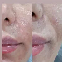 ژل و بوتاکس جوانساز
