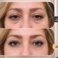 بلفاروپلاستی با تخفیف ویژه ۳ میلیونی
