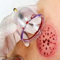 طب سنتی ، حجامت بادکش و تزریقات