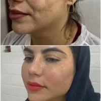 چربی زیبایی زنان/غبغب/بوتاکس/ژل/لابیاپلاستی