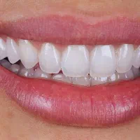دستیار دندانپزشکی زیبایی و جراحی ایمپلنت