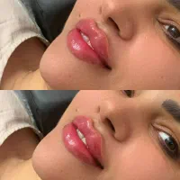 مدل رایگان ژل و بوتاکس