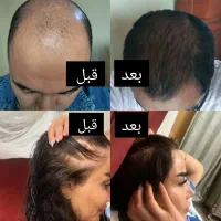رویش مجدد مو