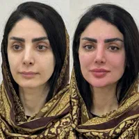 فیلر چهره بانوان هر سی سی 950