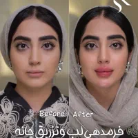 مدل فیلر و لیفت با نج‌جوانساز رایگان