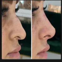 کوچک کردن بینی،رفع قوز بینی،سرپایی،بدون درد