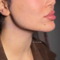 ساکشن غبغب ، لیفت با نخ و کانتورینگ صورت