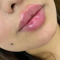 تزریق بوتاکس ژل لب گونه چونه درکلینیک توسط پزشک