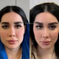 ژل بوتاکس لیفت نخ پی آر پی