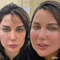 مرکز تزریق چربی در تهرانسر