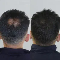 جوانسازی ناحیه کم پشت