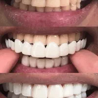 لمینت متحرک دندان  دو فک برند ترو اسمایل