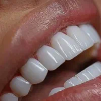 کامپوزیت دندان ، ونیر، لمینت ، عصب کشی ، جراحی