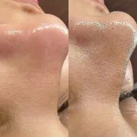 ماسک ذغال دشمن جوش‌های سرسیاه