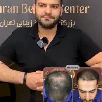 کاشت مو/ زیبایی/ ضمانت کتبی/توسط پزشک متخصص/اقساط