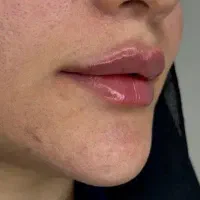 جشنواره تزریق ژل لب