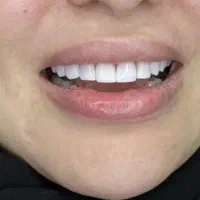 پالیش دندان