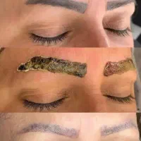 ریموو تتوهای قدیمی