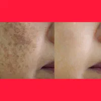 رفع لک / رفع لک بارداری / جای جوش / آفتاب سوختگی