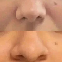 فرم دلخواه بینی ۲۰روزه