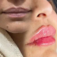 (کلینیک دنا)ژل بوتاکس لیزر نخ روشنی‌زیربغل وبیکینی