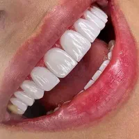خدمات تخصصی کامپوزیت دندان /آف ویژه
