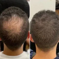 پرپشتی موهات رو از همین حالا آغاز کن