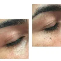 سفیدسازی پلکسر خالبرداری لیزر خال و لک فیشیال پوست