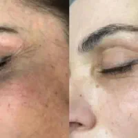 آموزش مزوایت کرم پودر دائم خودت خودتو سفید کن
