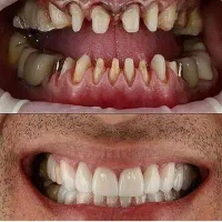 ایمپلنت اقتصادی با پرداخت اقساطی و مشاوره رایگان