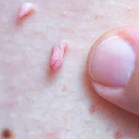 زگیل تناسلی را دست‌کم نگیرید