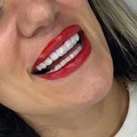 دندان پزشکی تخفیف ویژه کامپوزیت و لمینت