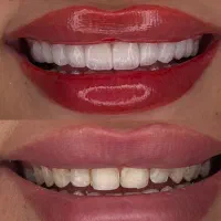 کامپوزیت زیبایی/کامپوزیت ونیر/کامپوزیت اقساطی