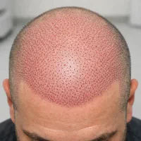تکنیسین کاشت مو