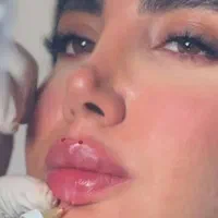 مجموعه تخصص هایفو ژل بوتاکس به مدت یک هفته 30درصد