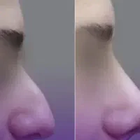 راهنمایی عمل بینی