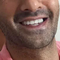 ساخت دندان مصنوعی بالاترین کیفیت