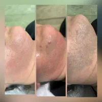 لیزر موهای زائد و کلیه خدمات زیبایی در مطب پزشک