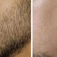 ریش و پشم|آرایشی، بهداشتی، درمانی|آق قلا, |دیوار