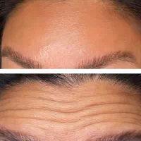 تزریق انواع بوتاکس و ژل ومزوژل